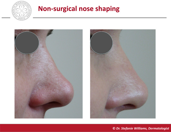 Non-Surgical Nose Reshaping Before and After
